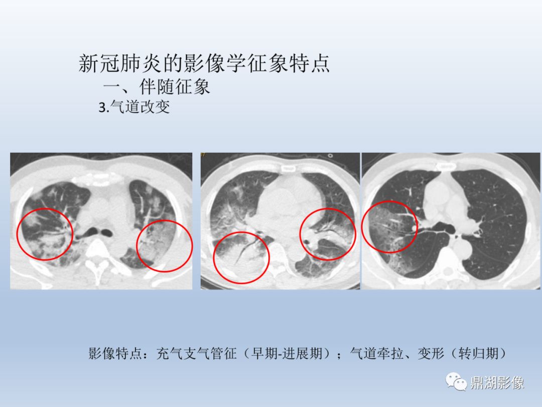 【PPT】新型冠状病毒感染的肺炎影像汇集