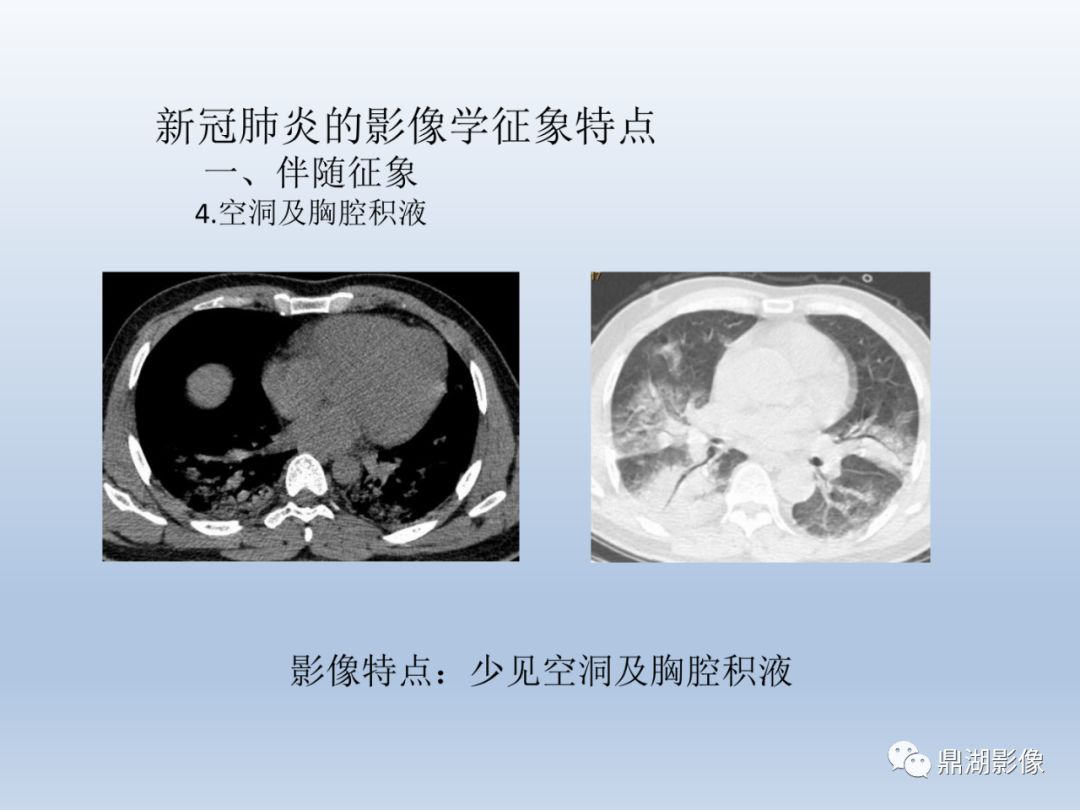 【PPT】新型冠状病毒感染的肺炎影像汇集
