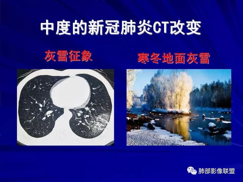 【PPT】新型冠状病毒肺炎CT征象识别及快速诊断