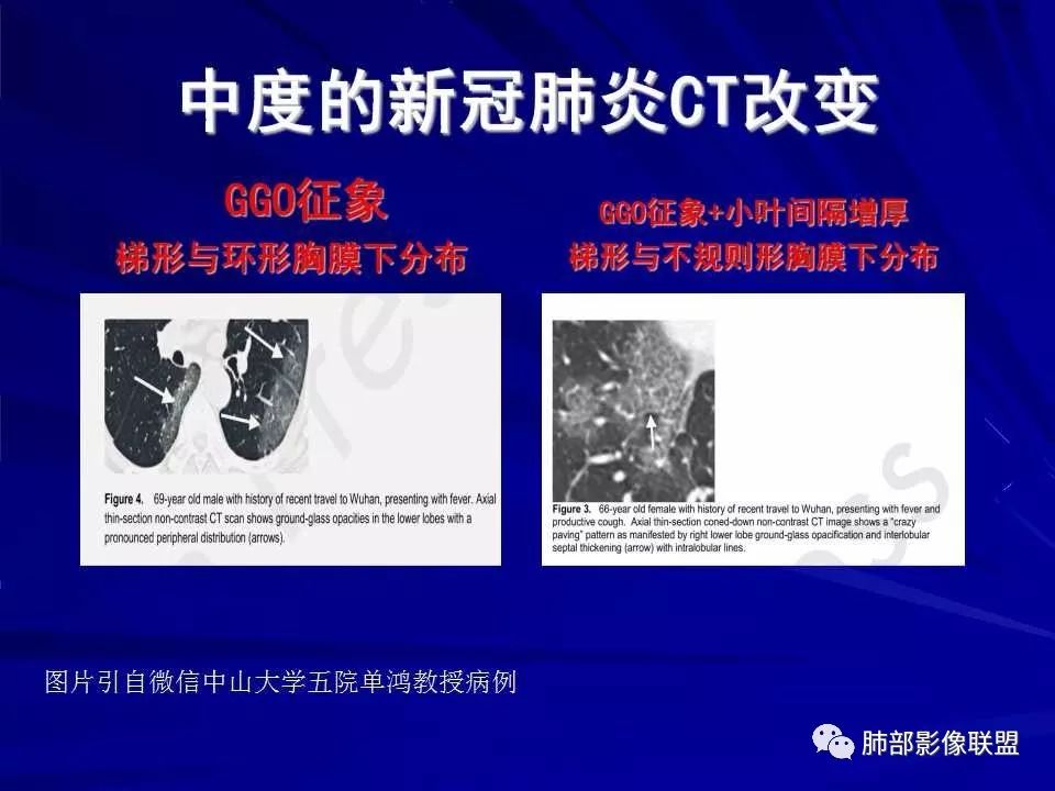 【PPT】新型冠状病毒肺炎CT征象识别及快速诊断