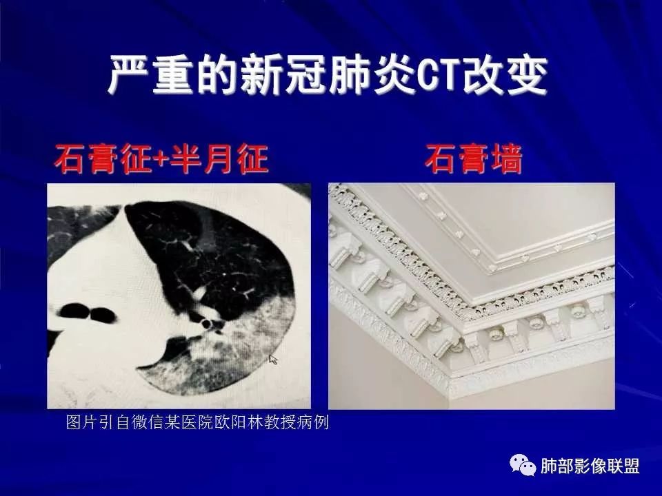 【PPT】新型冠状病毒肺炎CT征象识别及快速诊断