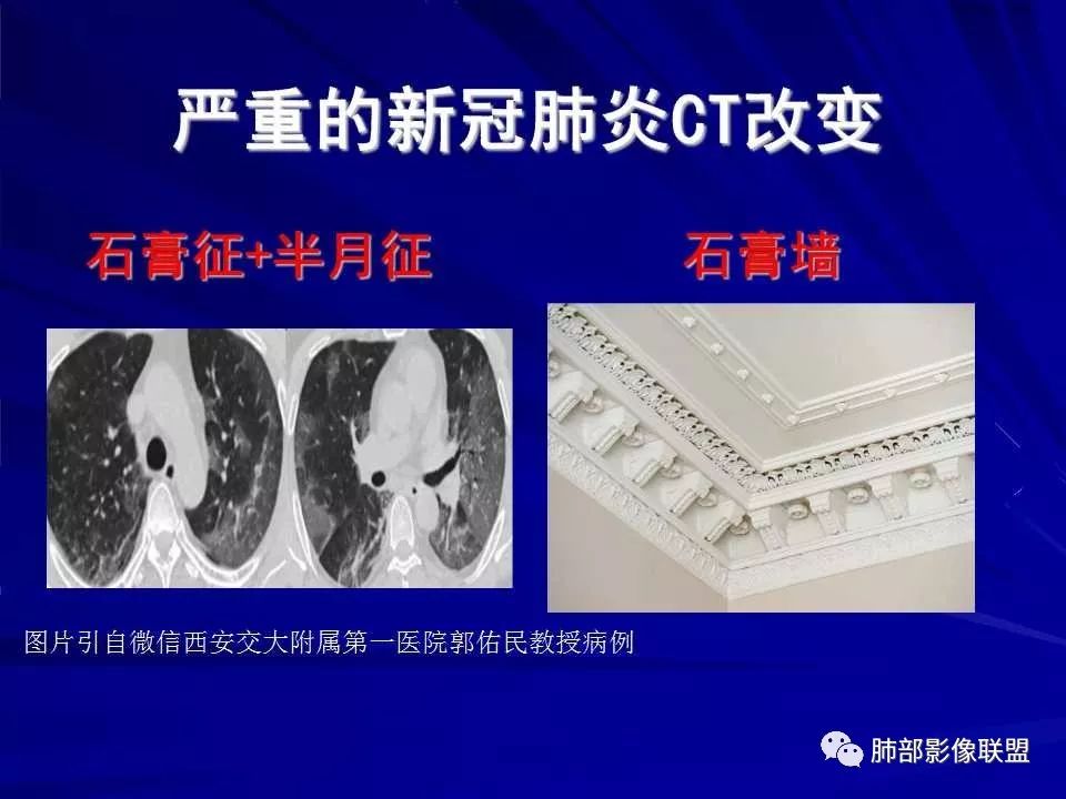 【PPT】新型冠状病毒肺炎CT征象识别及快速诊断