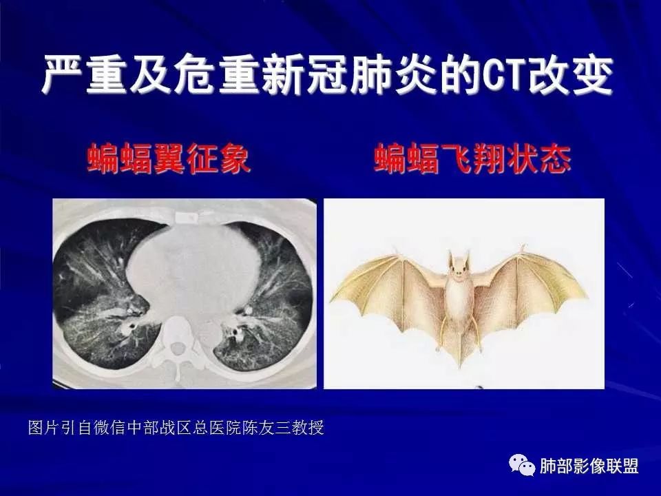 【PPT】新型冠状病毒肺炎CT征象识别及快速诊断
