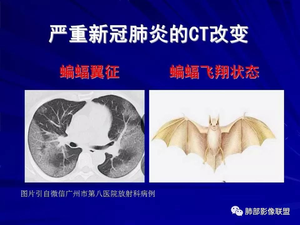 【PPT】新型冠状病毒肺炎CT征象识别及快速诊断