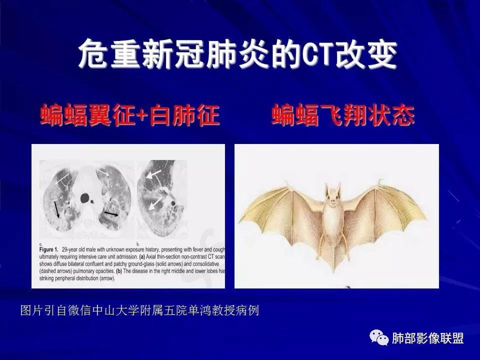 【PPT】新型冠状病毒肺炎CT征象识别及快速诊断