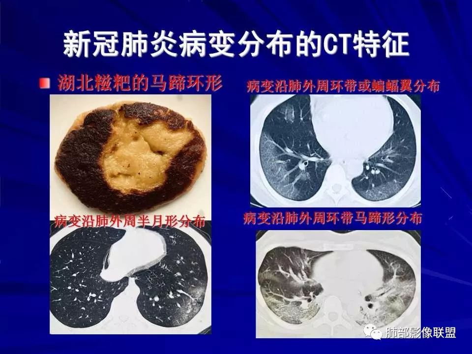 【PPT】新型冠状病毒肺炎CT征象识别及快速诊断