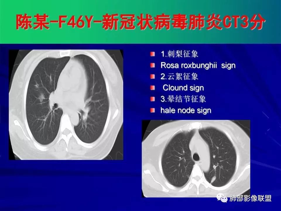 【PPT】新型冠状病毒肺炎CT征象识别及快速诊断