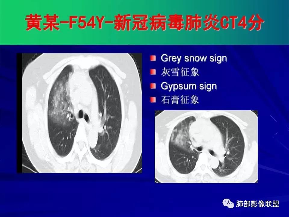 【PPT】新型冠状病毒肺炎CT征象识别及快速诊断