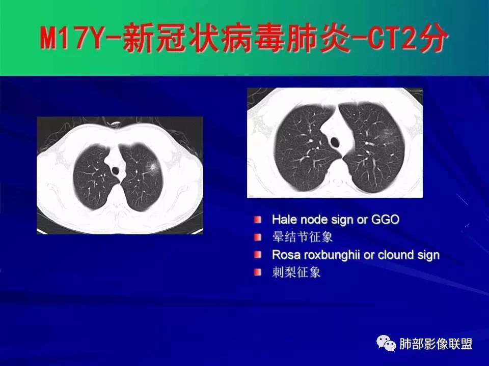 【PPT】新型冠状病毒肺炎CT征象识别及快速诊断