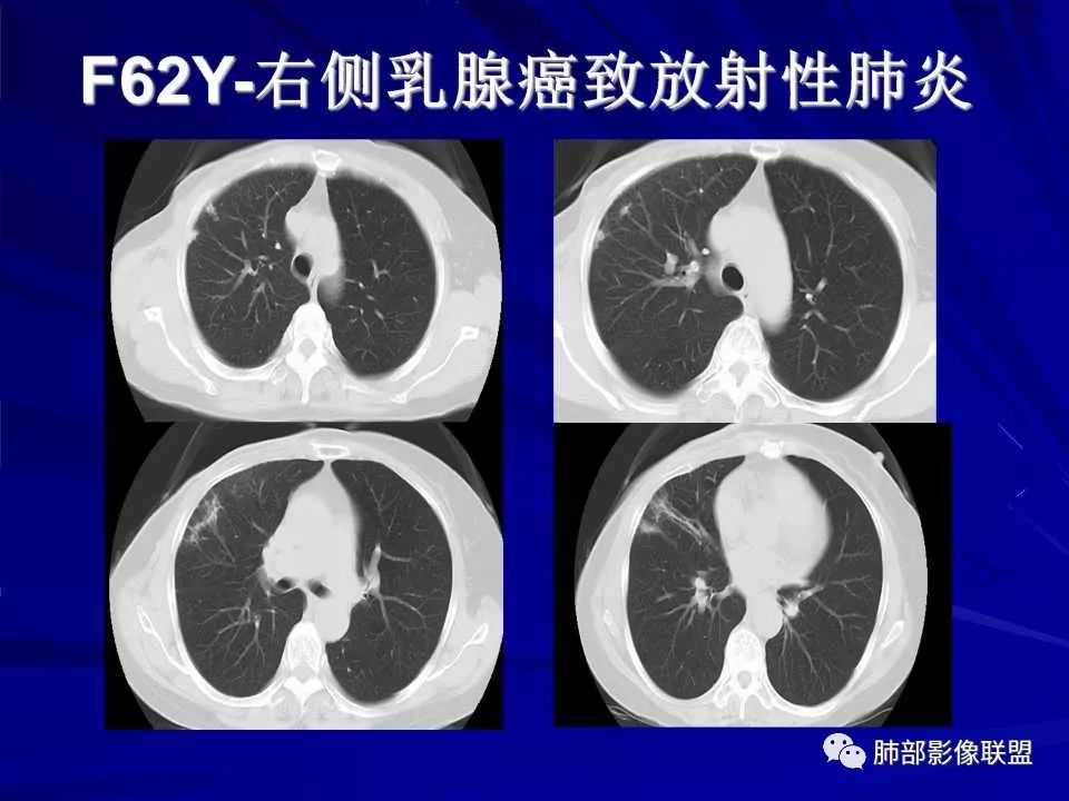【PPT】新型冠状病毒肺炎CT征象识别及快速诊断