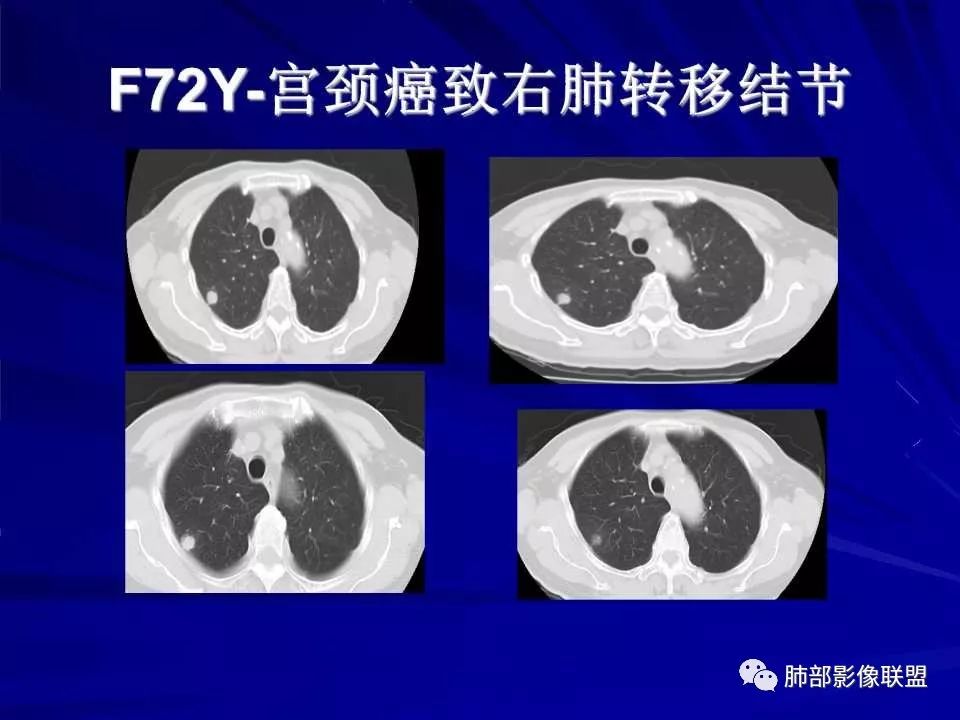 【PPT】新型冠状病毒肺炎CT征象识别及快速诊断