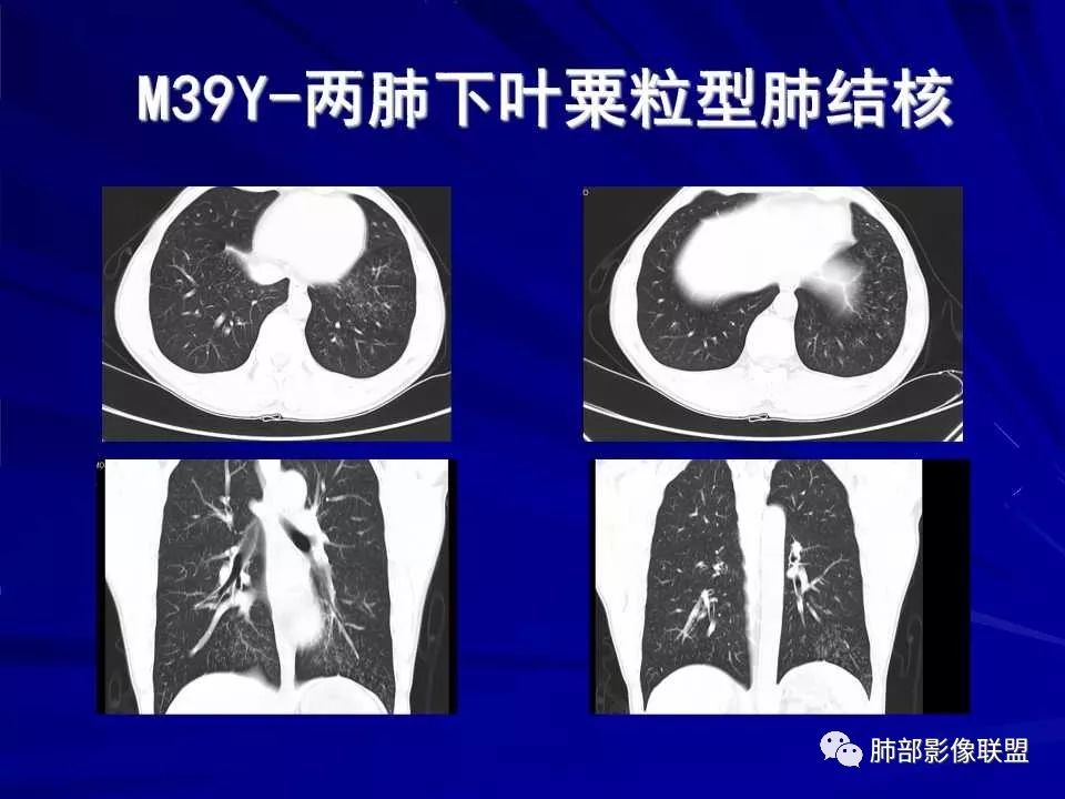 【PPT】新型冠状病毒肺炎CT征象识别及快速诊断
