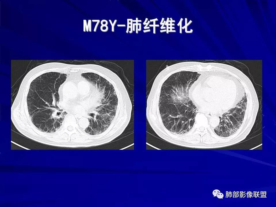 【PPT】新型冠状病毒肺炎CT征象识别及快速诊断
