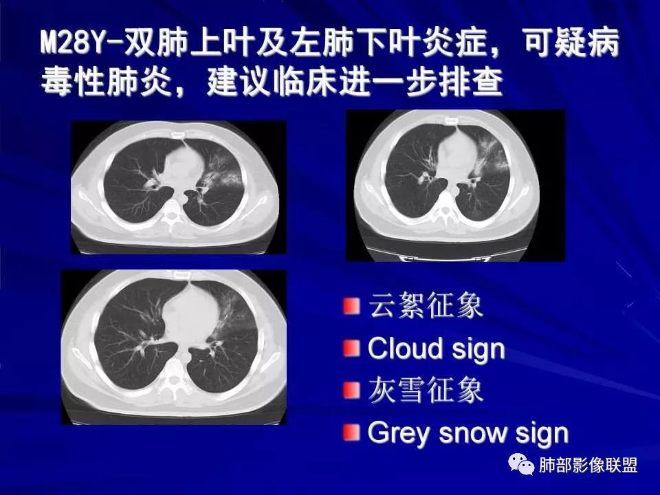 【PPT】新型冠状病毒肺炎CT征象识别及快速诊断