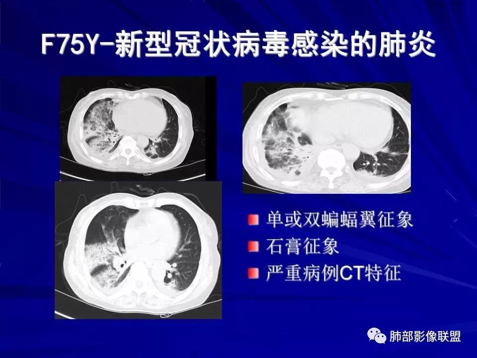【PPT】新型冠状病毒肺炎CT征象识别及快速诊断