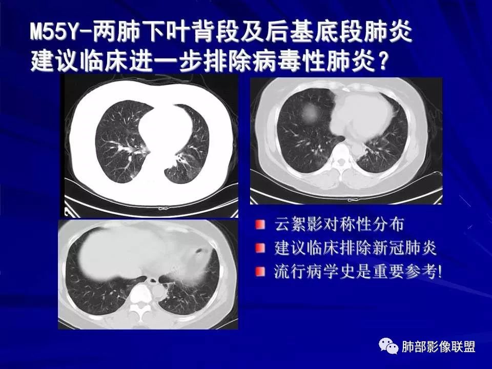 【PPT】新型冠状病毒肺炎CT征象识别及快速诊断