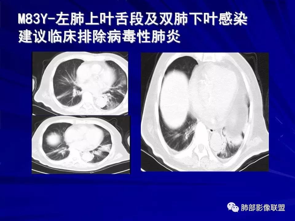 【PPT】新型冠状病毒肺炎CT征象识别及快速诊断