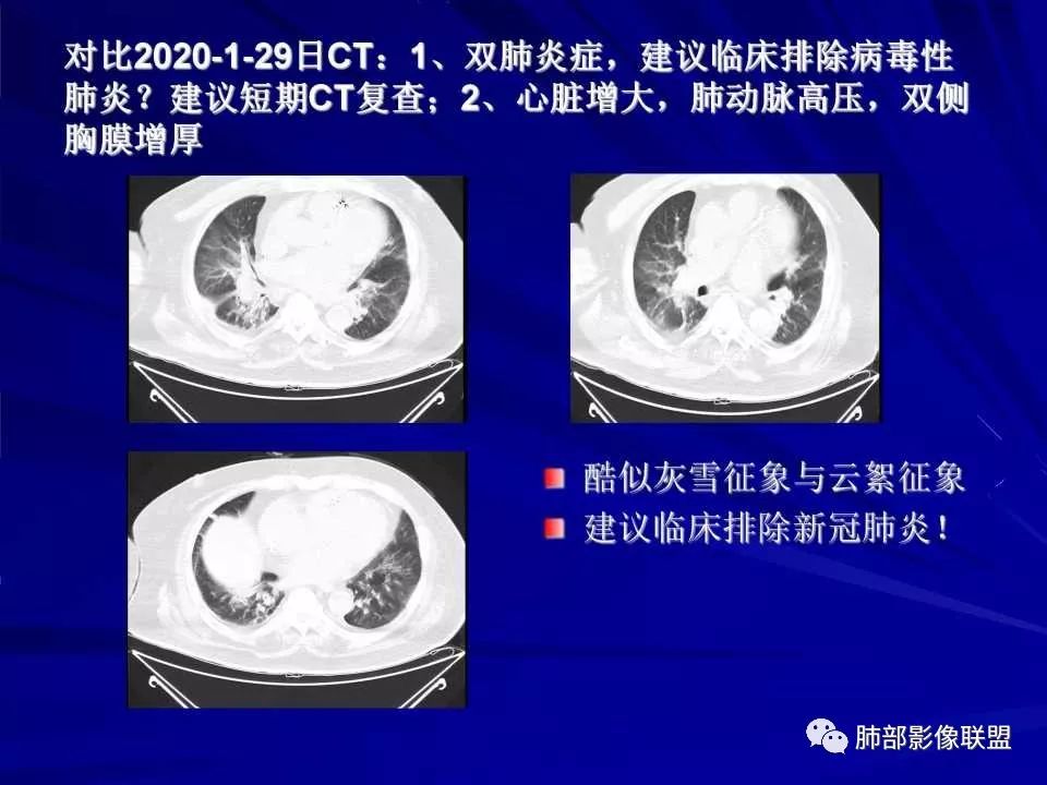 【PPT】新型冠状病毒肺炎CT征象识别及快速诊断