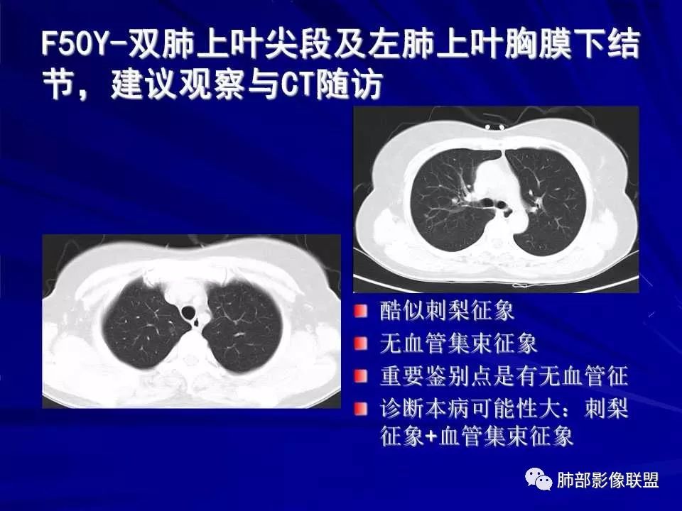 【PPT】新型冠状病毒肺炎CT征象识别及快速诊断