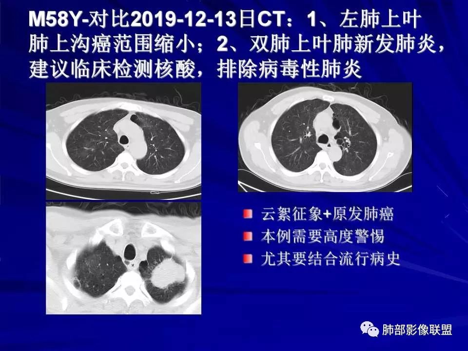 【PPT】新型冠状病毒肺炎CT征象识别及快速诊断