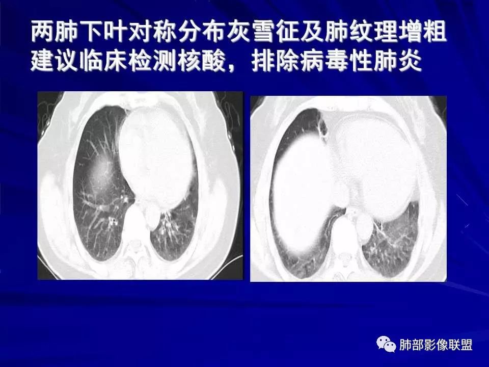 【PPT】新型冠状病毒肺炎CT征象识别及快速诊断