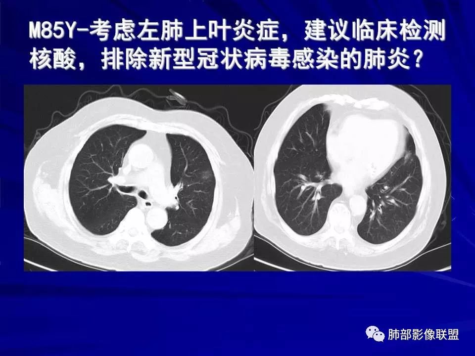 【PPT】新型冠状病毒肺炎CT征象识别及快速诊断