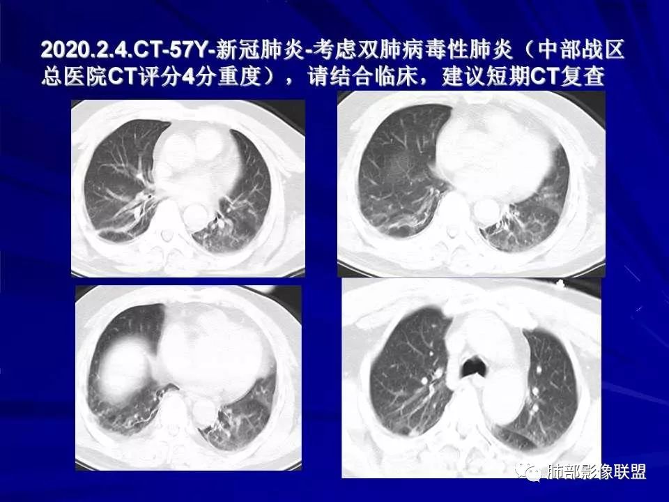 【PPT】新型冠状病毒肺炎CT征象识别及快速诊断