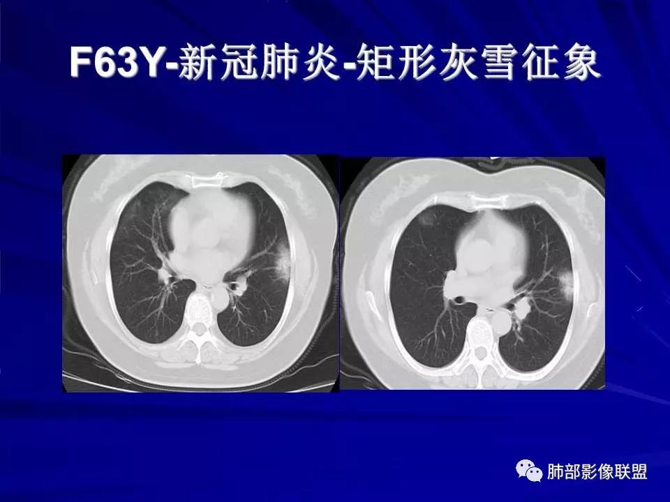【PPT】新型冠状病毒肺炎CT征象识别及快速诊断
