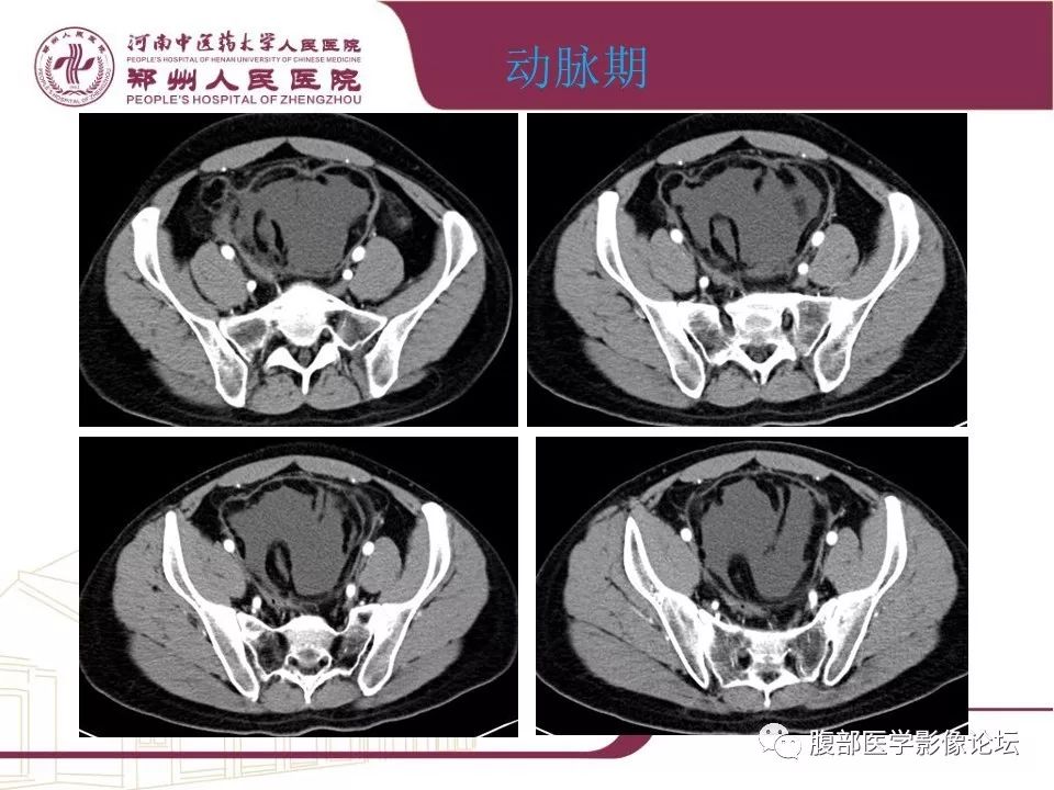 【病例】腹部脂肪坏死1例CT影像表现