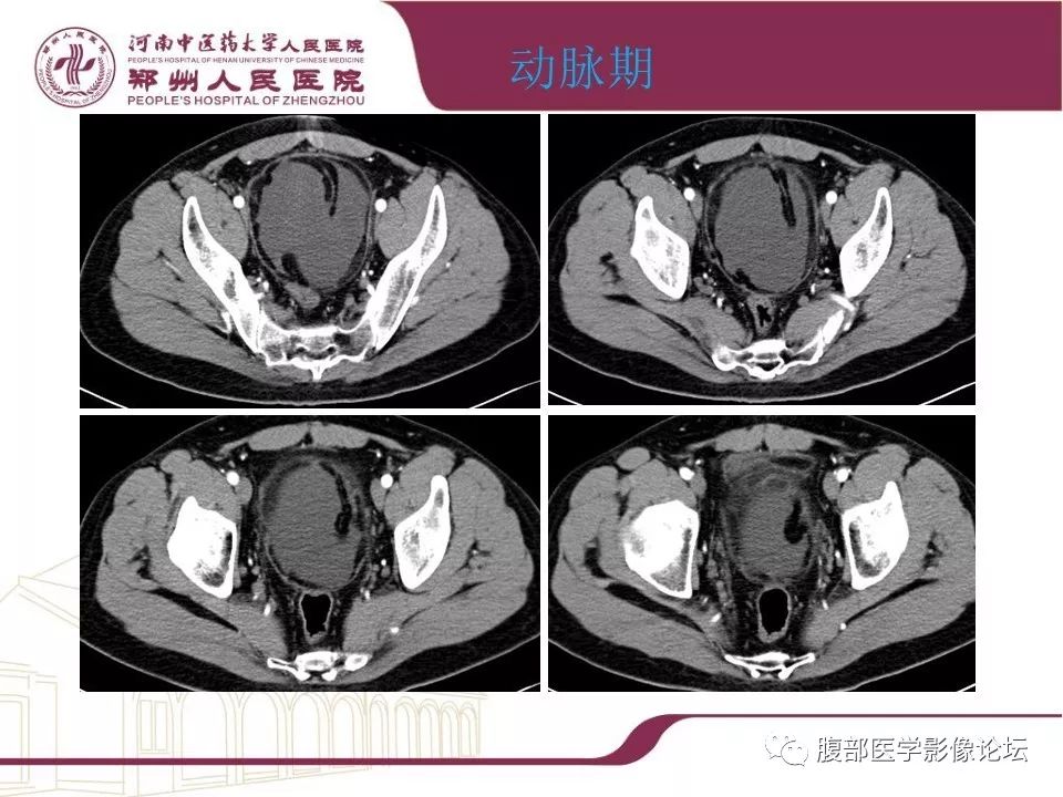 【病例】腹部脂肪坏死1例CT影像表现