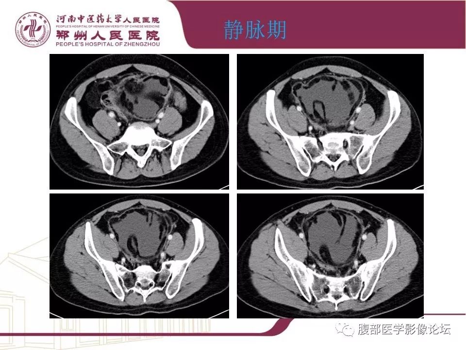【病例】腹部脂肪坏死1例CT影像表现