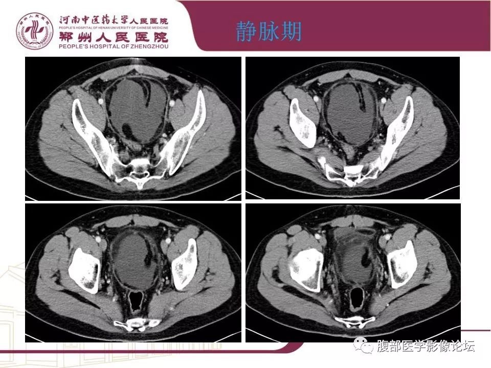 【病例】腹部脂肪坏死1例CT影像表现