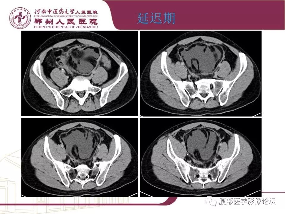 【病例】腹部脂肪坏死1例CT影像表现