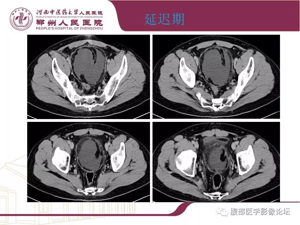 【病例】腹部脂肪坏死1例CT影像表现