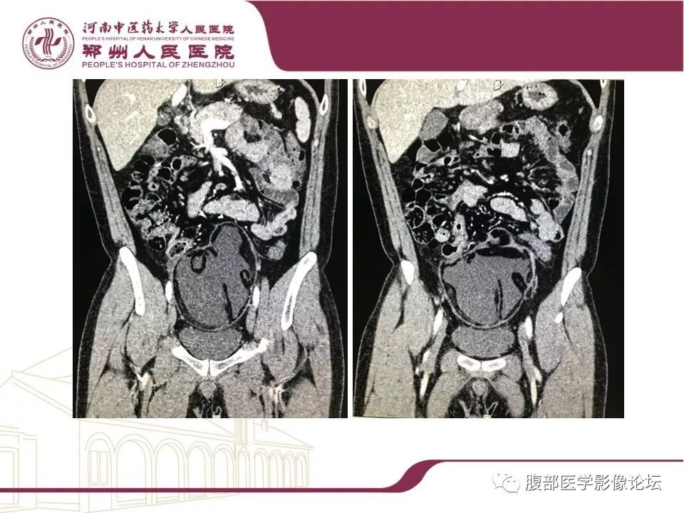 【病例】腹部脂肪坏死1例CT影像表现