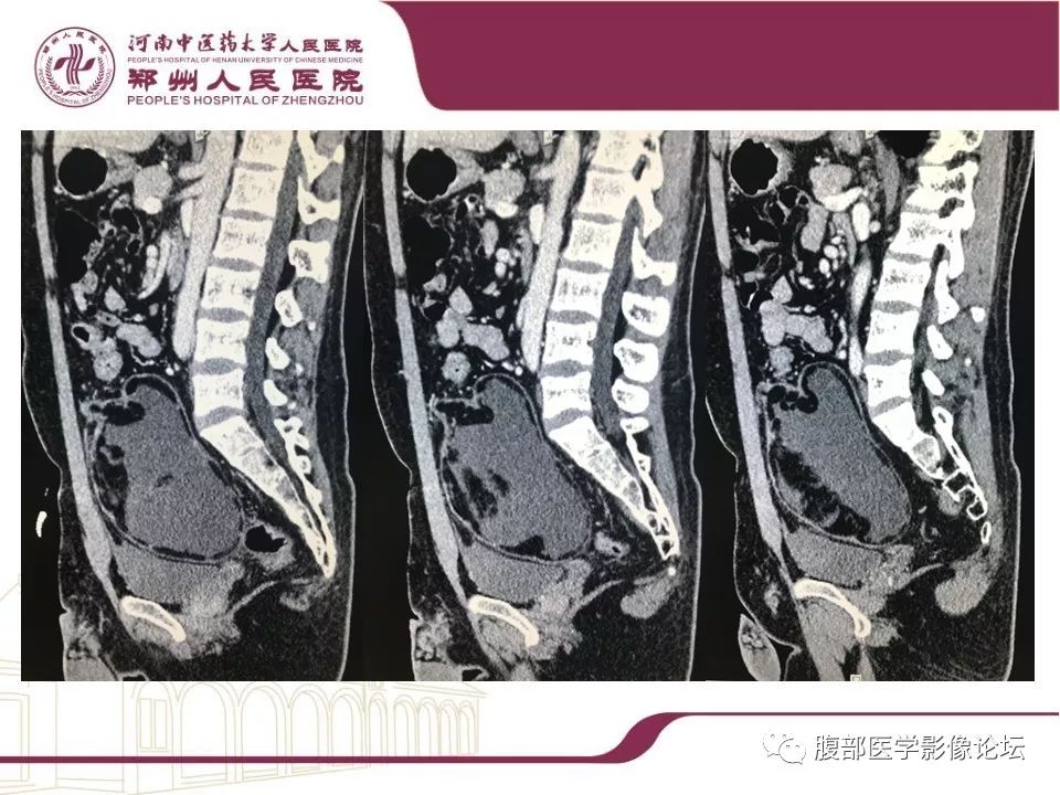 【病例】腹部脂肪坏死1例CT影像表现