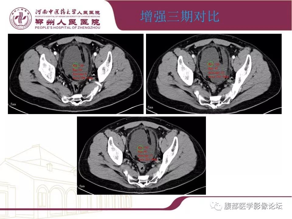 【病例】腹部脂肪坏死1例CT影像表现