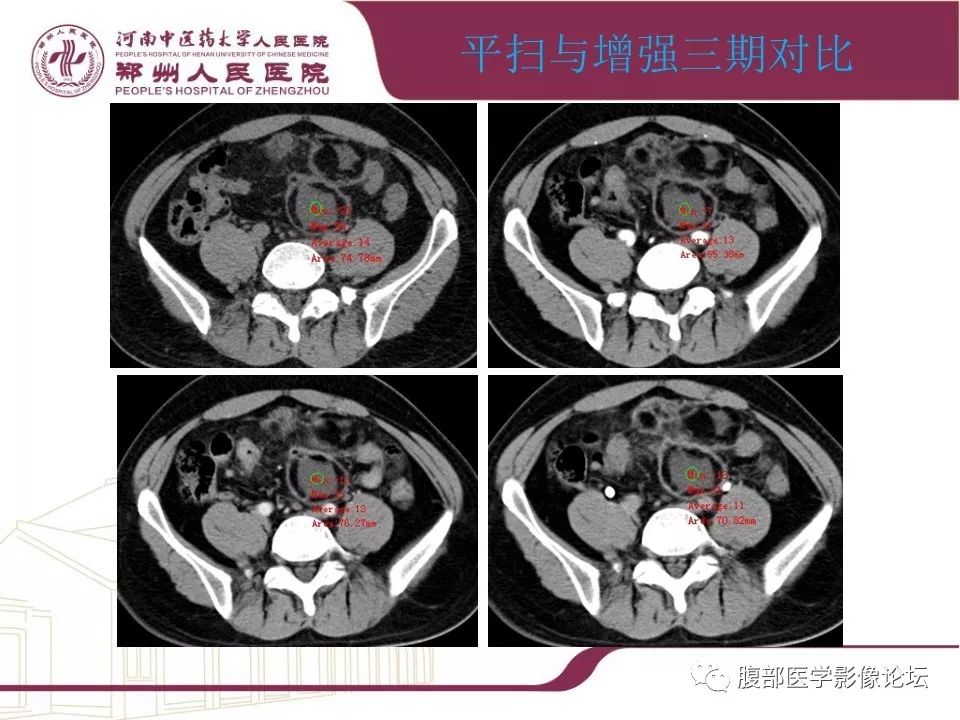 【病例】腹部脂肪坏死1例CT影像表现