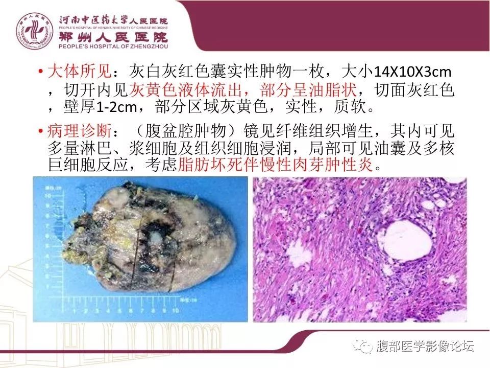 【病例】腹部脂肪坏死1例CT影像表现