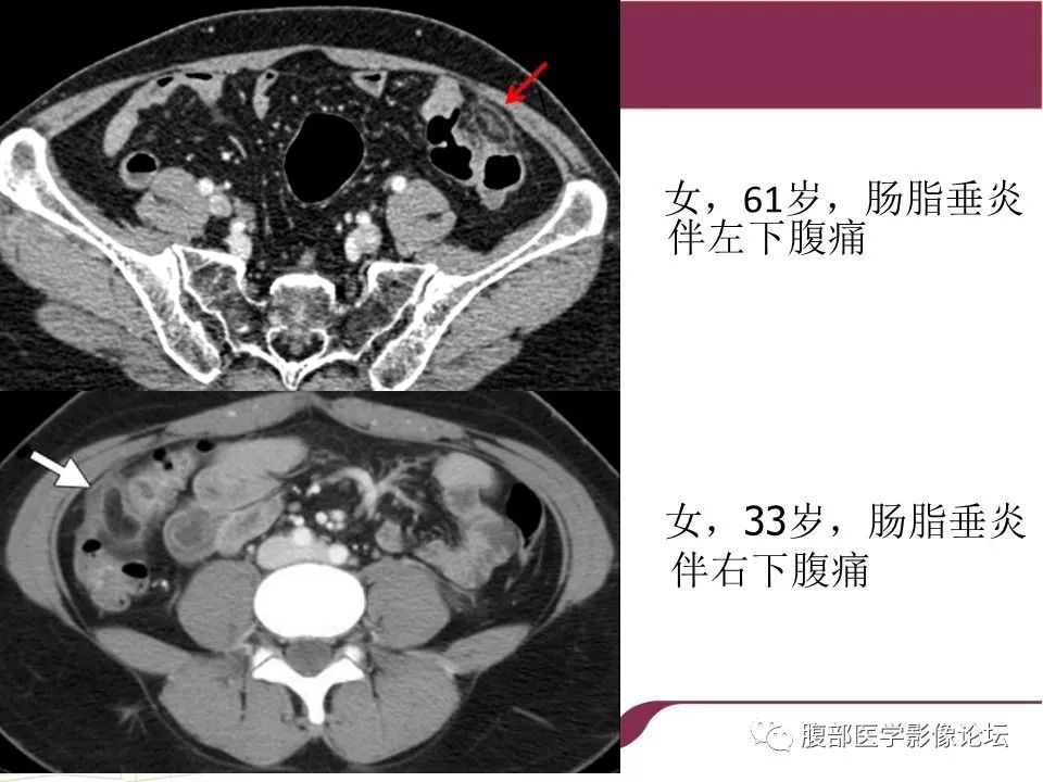 【病例】腹部脂肪坏死1例CT影像表现