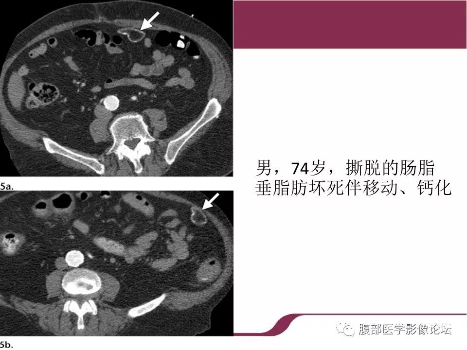 【病例】腹部脂肪坏死1例CT影像表现