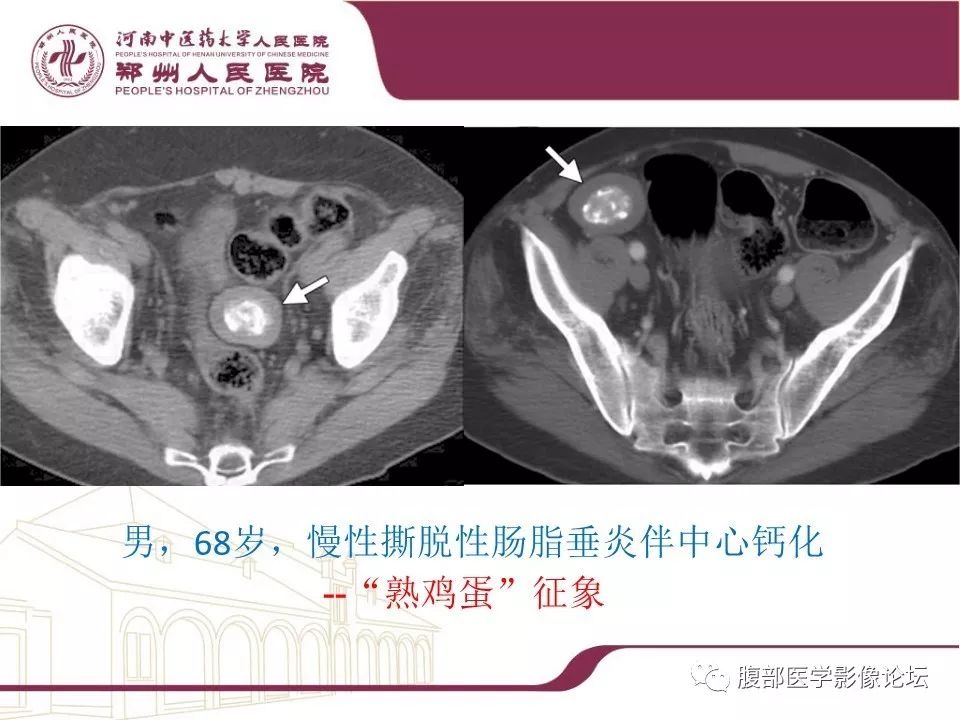 【病例】腹部脂肪坏死1例CT影像表现