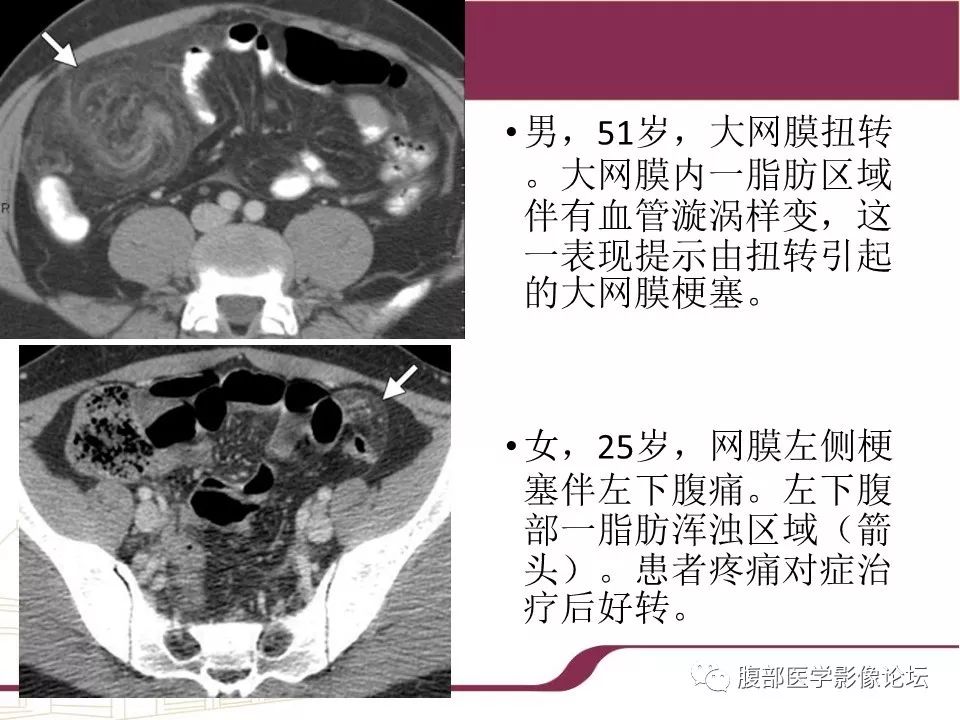 【病例】腹部脂肪坏死1例CT影像表现
