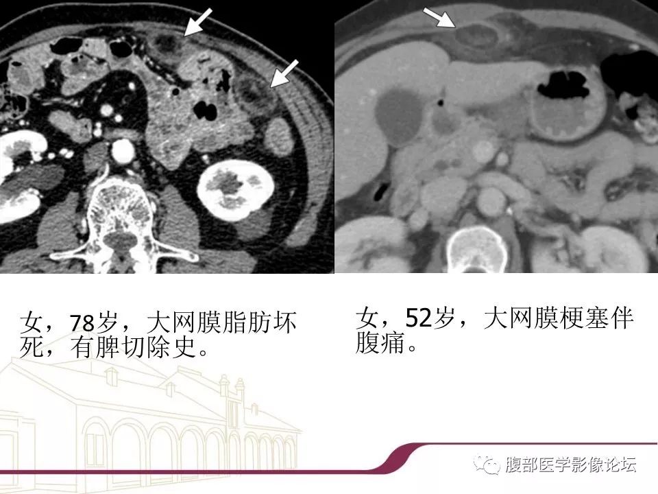【病例】腹部脂肪坏死1例CT影像表现