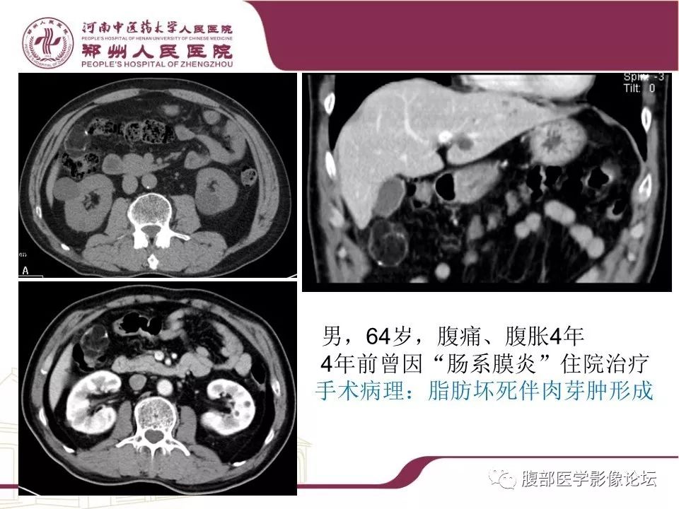 【病例】腹部脂肪坏死1例CT影像表现