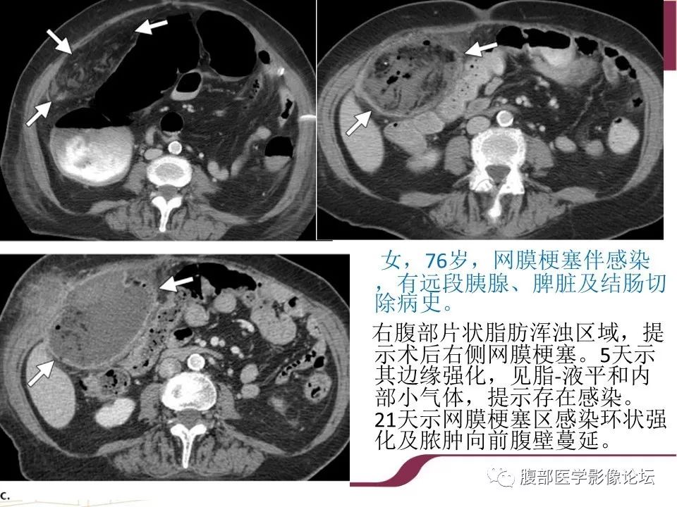 【病例】腹部脂肪坏死1例CT影像表现