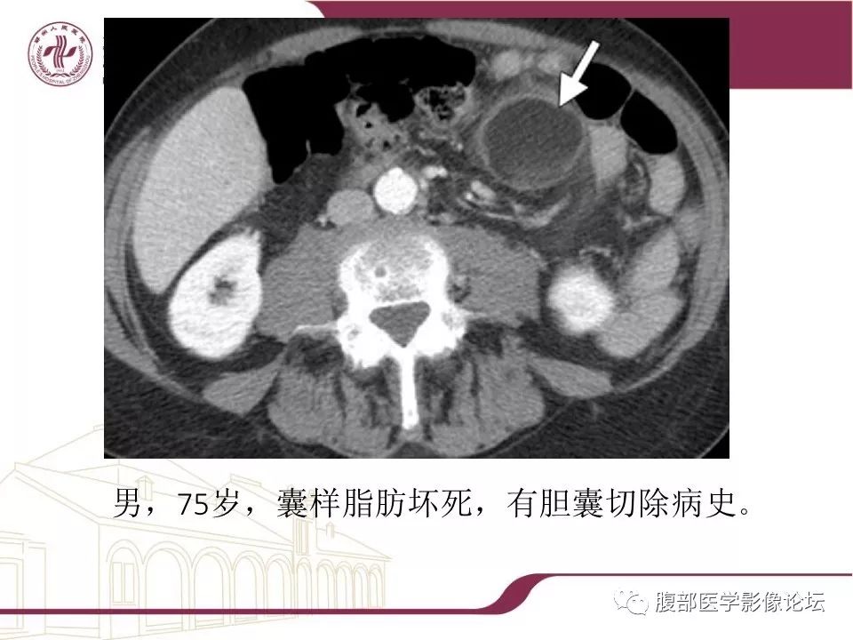 【病例】腹部脂肪坏死1例CT影像表现