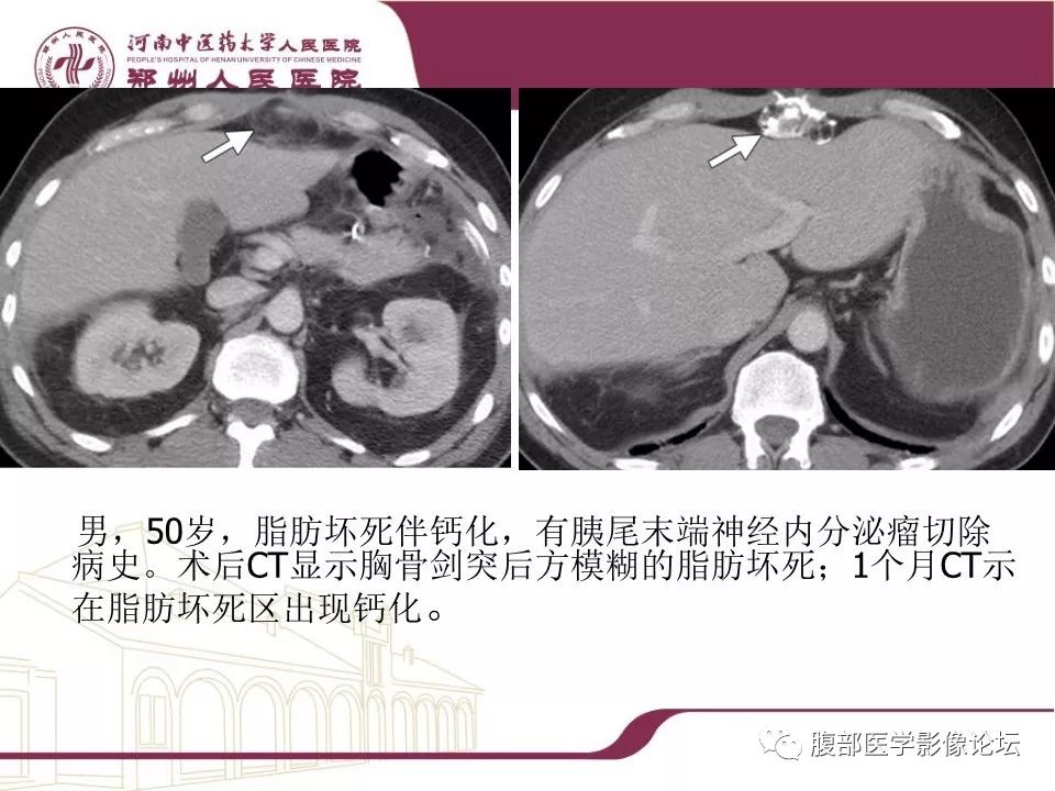 【病例】腹部脂肪坏死1例CT影像表现