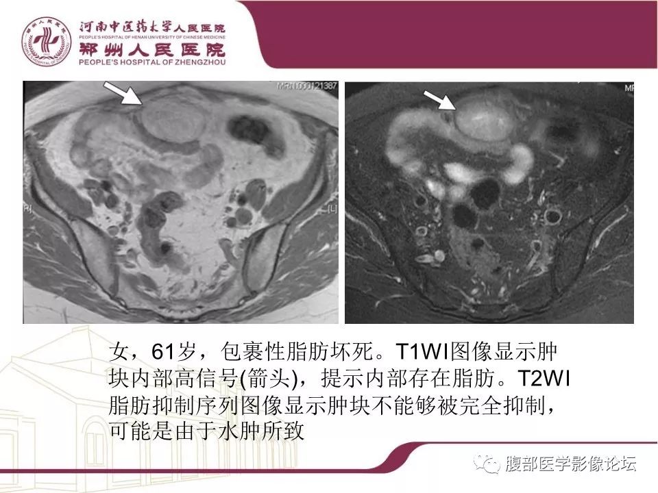 【病例】腹部脂肪坏死1例CT影像表现