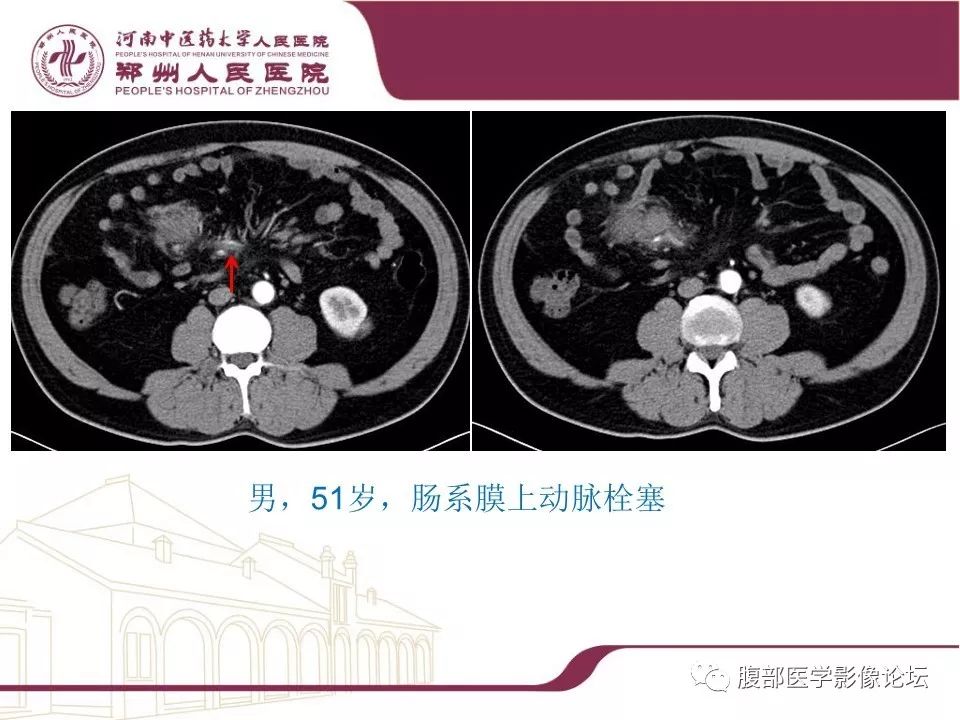 【病例】腹部脂肪坏死1例CT影像表现